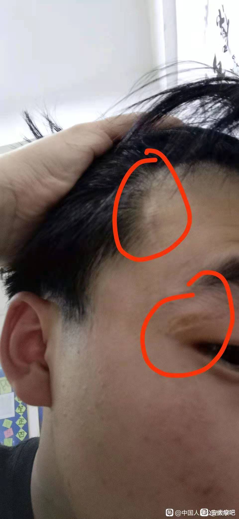 求助,关于脸上疤痕的问题